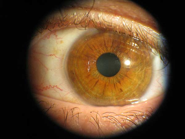 Augendiagnose Irisdiagnose Heilpraktikerin Pankow